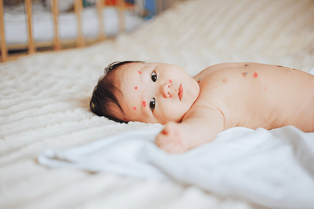 Baby Acne