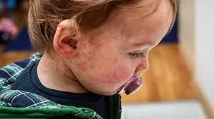 Food Allergies in Babies Food Allergies in Babies