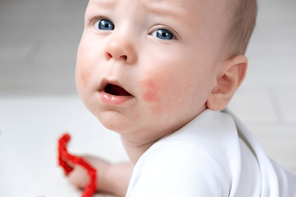 Baby Acne
